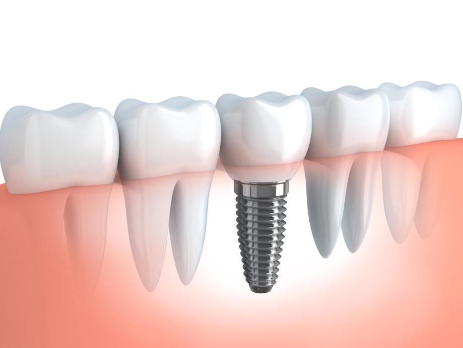 dental implants in santa monica