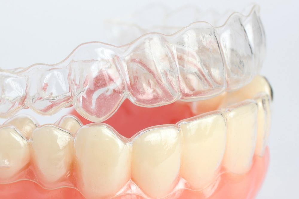 invisalign clear aligners in santa monica