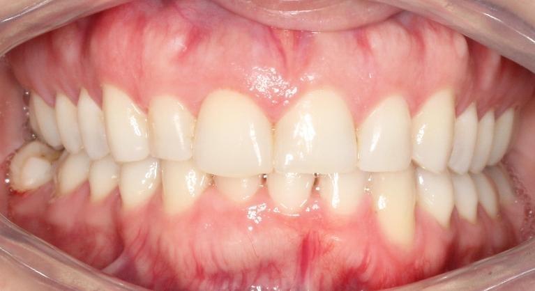 Invisalign in Santa Monica | After
