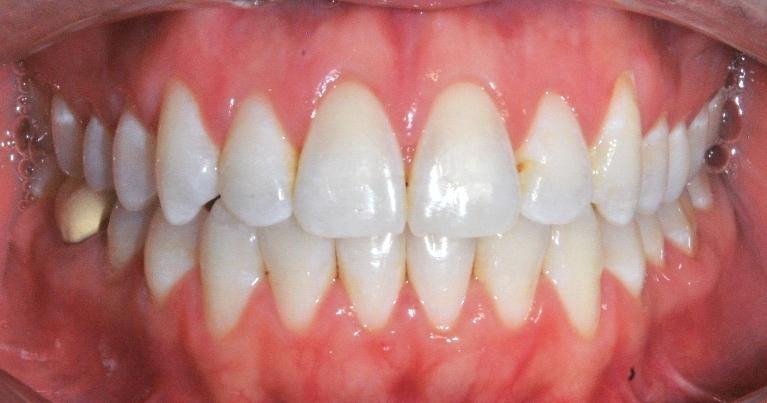 Invisalign in Santa Monica | After