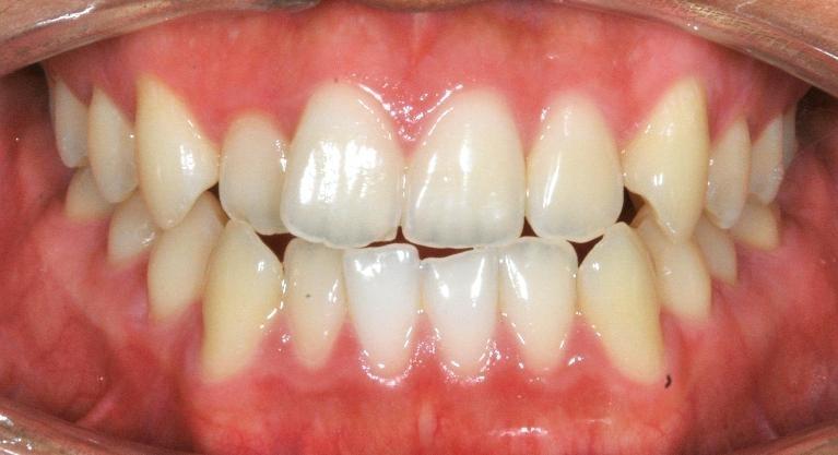Braces and TADs Smile Transformation | before