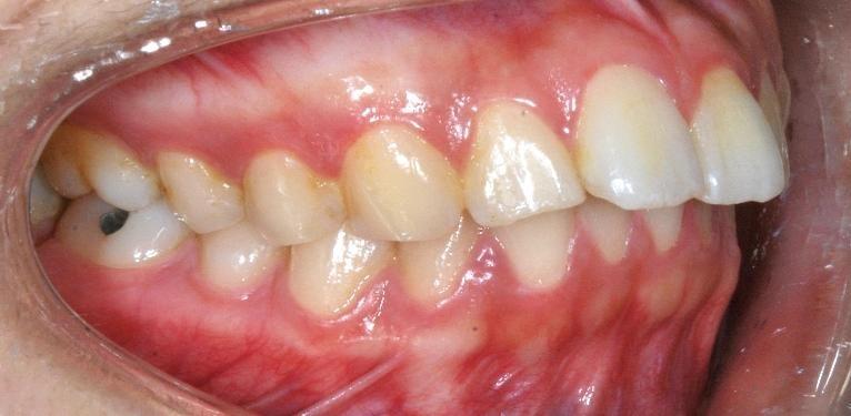 Invisalign in Santa Monica | Before & After