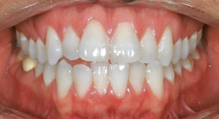 Invisalign in Santa Monica | Before