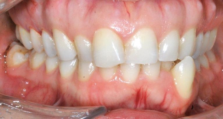 Invisalign in Santa Monica | Before